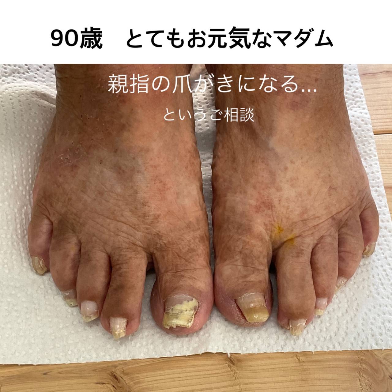 お年寄りのフットケア