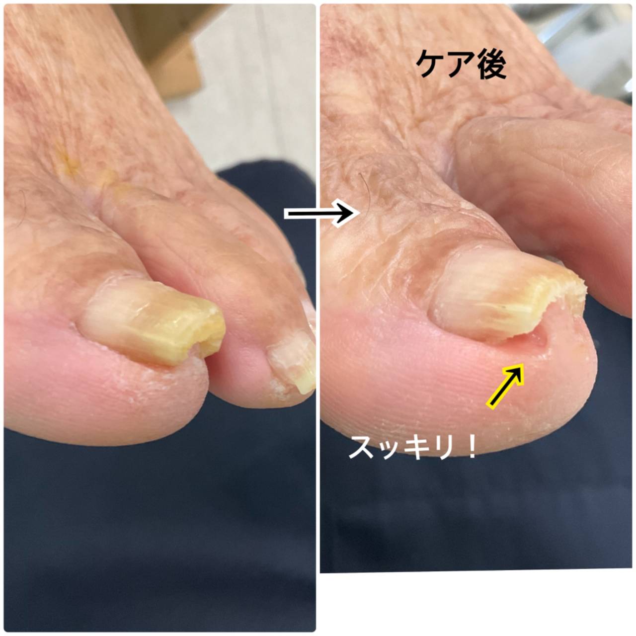 お年寄りの足爪切りもお任せください