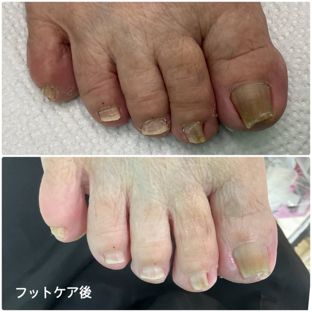 高齢者のフットケア