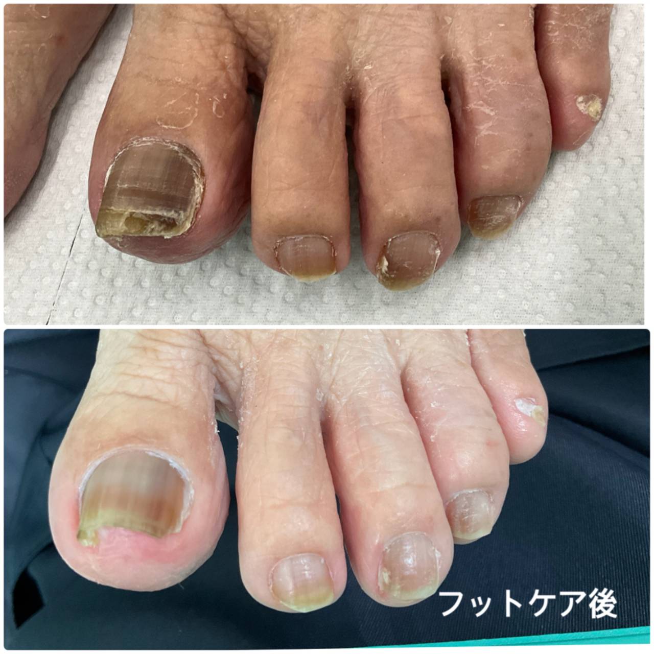 高齢者の足の爪ケア、分厚い爪