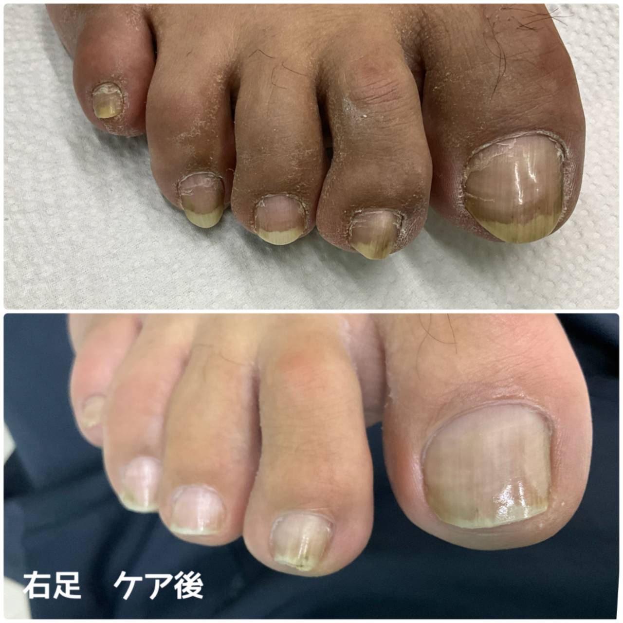 専門店でのフットケア