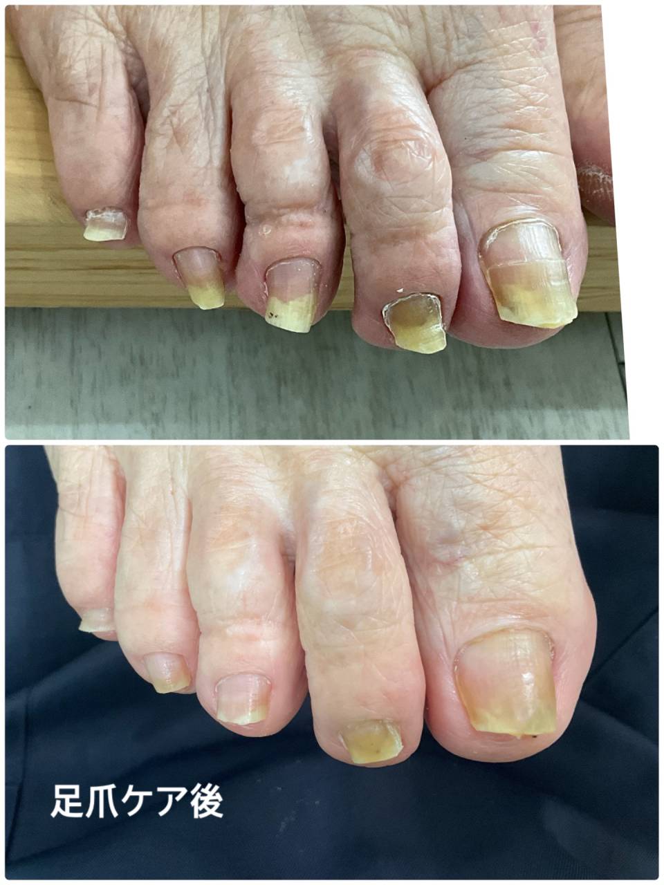 高齢者の足爪ケア