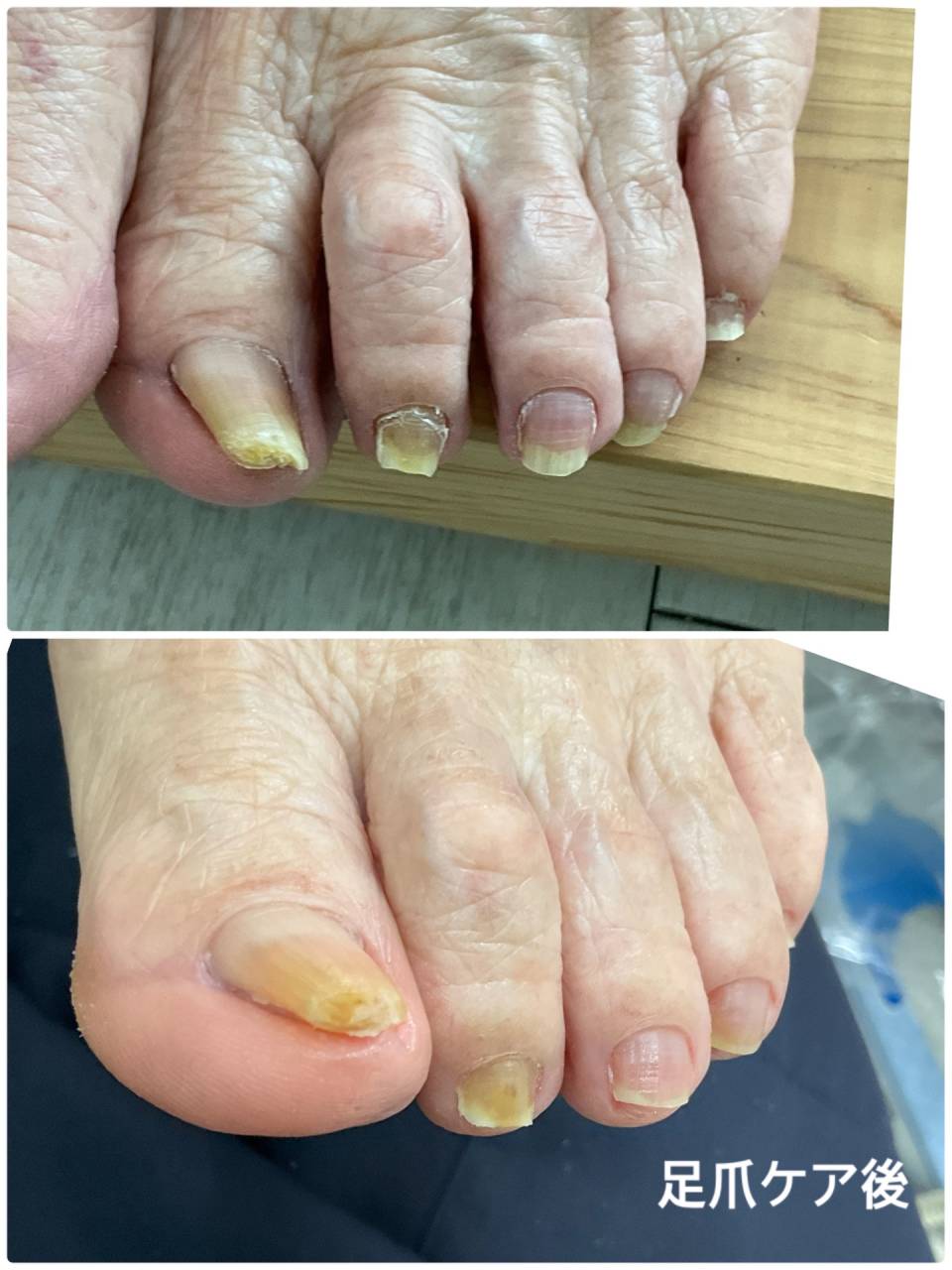高齢者の足爪ケア
